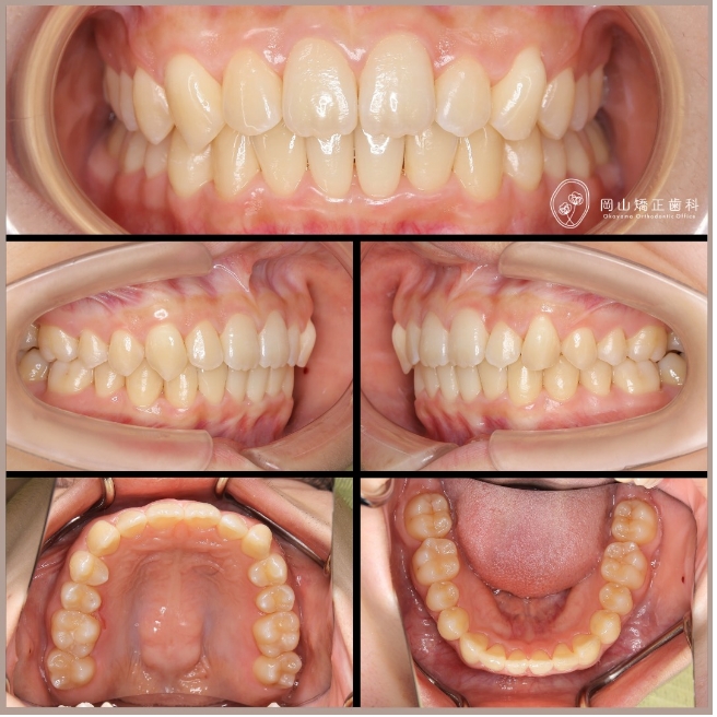 メル20723】アライナー矯正歯科治療 アライナー矯正歯科治療 | Sandra