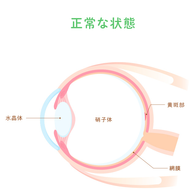 硝子体手術｜奥田眼科｜学園前診療所｜奈良市にある眼科