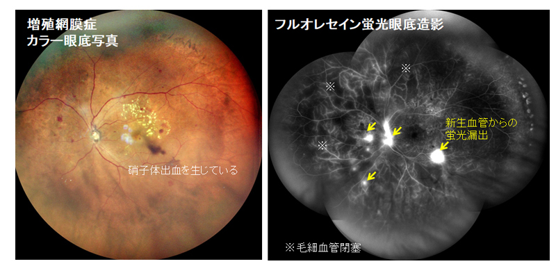 診療内容 -糖尿病網膜症-｜札幌 桑園 おくしば眼科