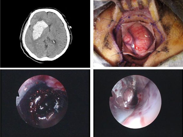 神経内視鏡手術について｜王子総合病院