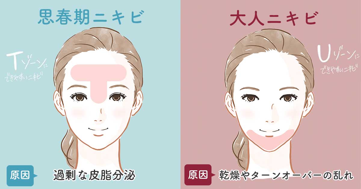 思春期ニキビのスキンケアおすすめランキングを発表！中学生・高校生の