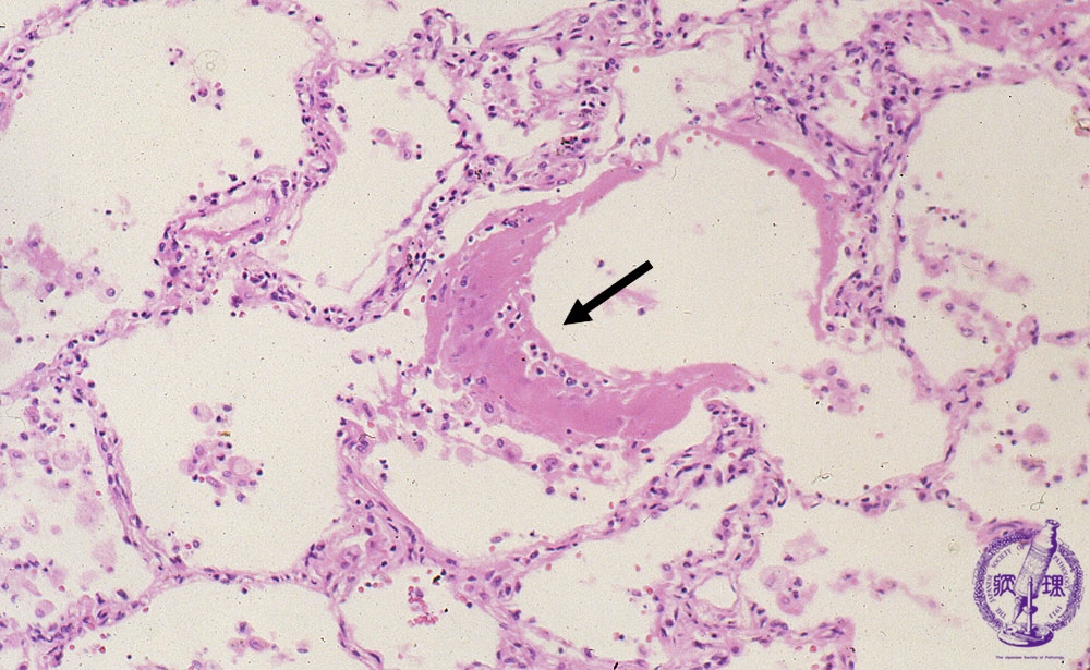 5.肺・胸膜 (12)間質性肺炎（びまん性肺胞傷害DAD／急性間質性肺炎AIP