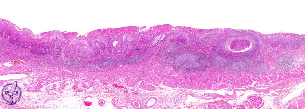 8.食道・胃 (3)食道癌（扁平上皮癌）|病理コア画像