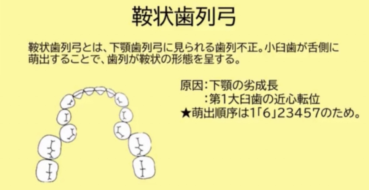 国試で問われやすい歯列弓は3つ。 特に⭐️鞍状歯列弓は重要です。