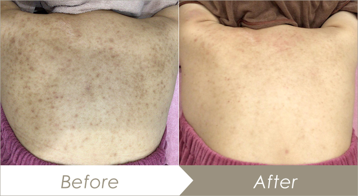 ミラノリピールボディ｜大阪の美容皮膚科プライベートスキンクリニック