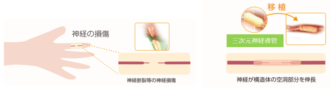 バイオ3Dプリンタを用いた末梢神経損傷に対する三次元神経導管の医師