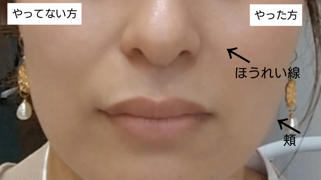 パイラナイト美顔器試してみた結果が凄い！【白石市・プライベート