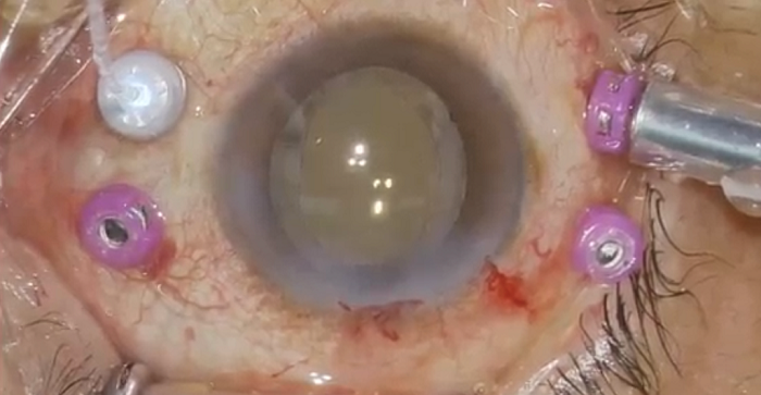 当科の極小切開硝子体手術 患者負担軽減を目指した27ゲージの選択