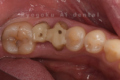 歯の移植「自家歯牙移植」｜両国Ai歯科クリニック｜両国駅、森下駅徒歩