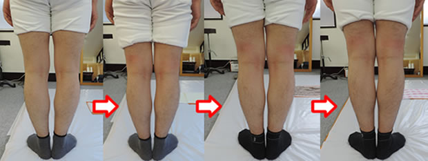 O脚矯正 | 開業して31年【側弯症専門】千葉整体サクシタ療法院