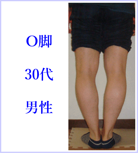 O脚矯正 | 新宿・笹塚のO脚、骨盤矯正「めぐみ整骨院」