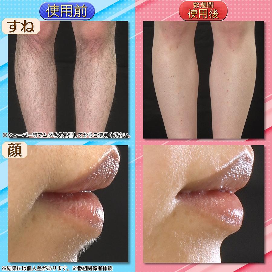 リファ エピ ゴー（ReFa EPI GO） / MTG RE-AR-02A エピゴー 脱毛 光