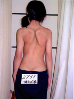 側湾症 脊柱側湾症 代償性 【大塚整体治療院】 そくわん症 側わん症 側弯症