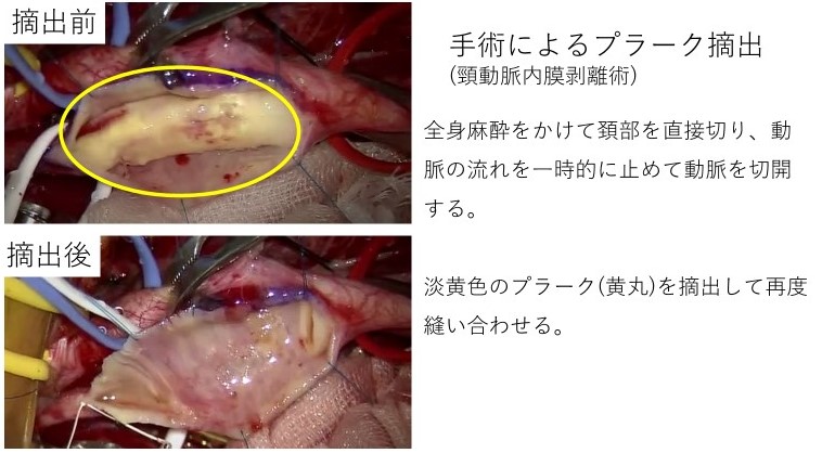 Neuroinfo Japan：頚動脈狭窄症
