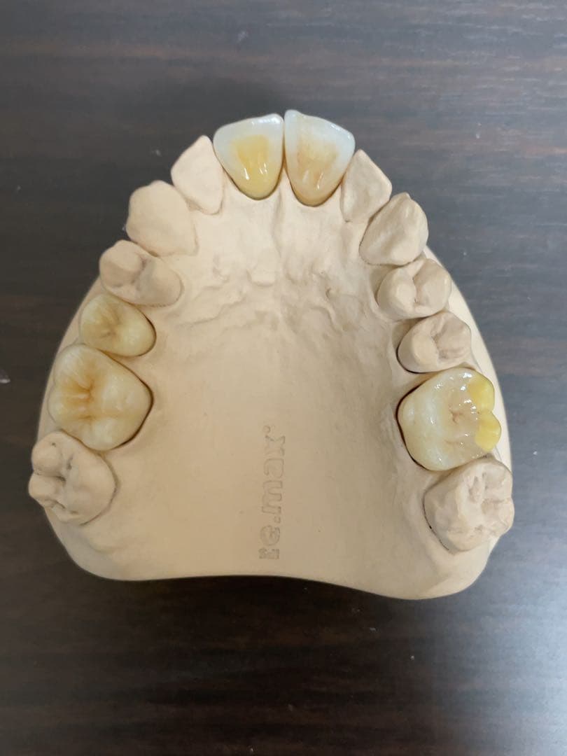 歯科技工　イーマックスサンプル模型　65116 歯科医院などのサンプルに！ e.maxとは？歯科医師が解説する基礎知識・メリットデメリット・適応
